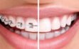 braces-before-after-DENTCARE-JBR