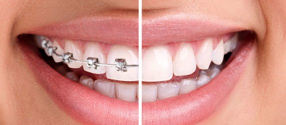 braces-before-after-DENTCARE-JBR