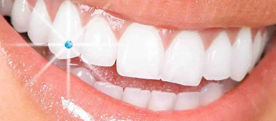 Whitening-and-Dental-Jewellery-DENTCARE-dhcc