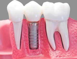 Prosthodontics-dentcare