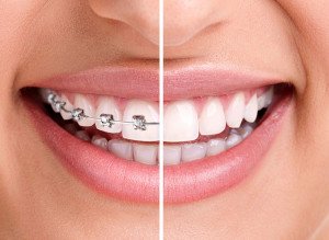 braces-before-after-dentcare