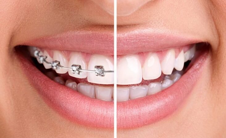 invisalign-braces-teenedit-dentcare