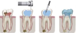 root-canal-treatment-dentcare