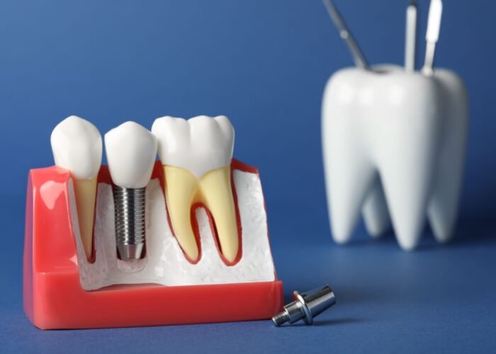 educational-model-of-gum-with-dental-implant-betwe-2026-01-28-17-02-48-utc (1)